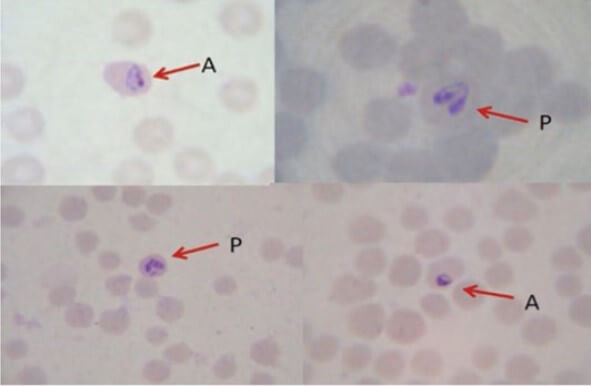 Formas parasitarias de Babesia bigemina observadas en frotis sanguíneos. A, Trofozoito anular; B, trofozoito piriforme doble.