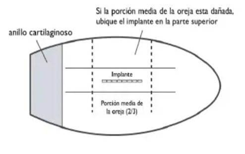 Posición anatómica correcta del implante en la oreja. (Arias, 2013).